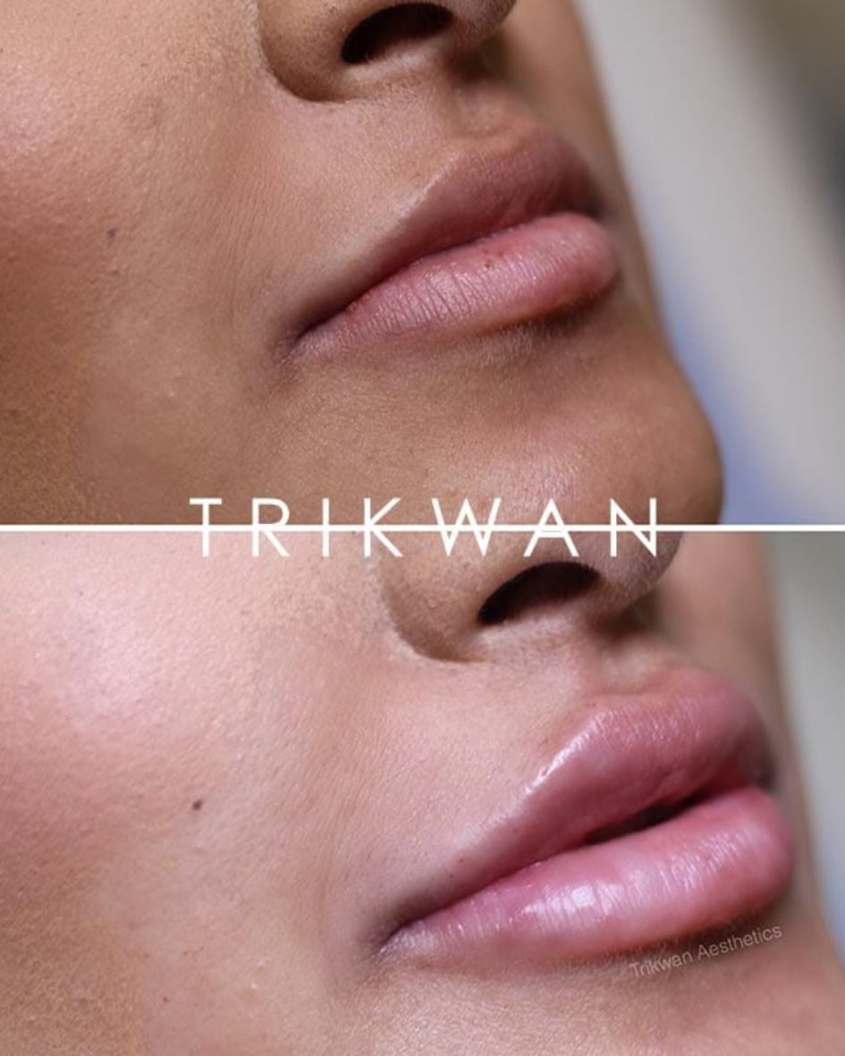 Lip filler before and after 2 — Trikwan Aesthetics