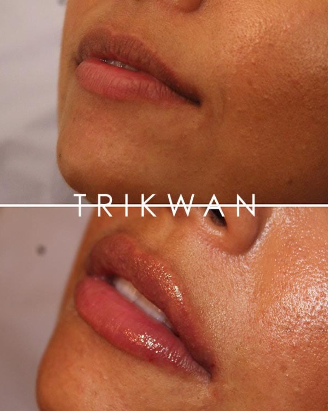 Lip filler before and after 1 — Trikwan Aesthetics