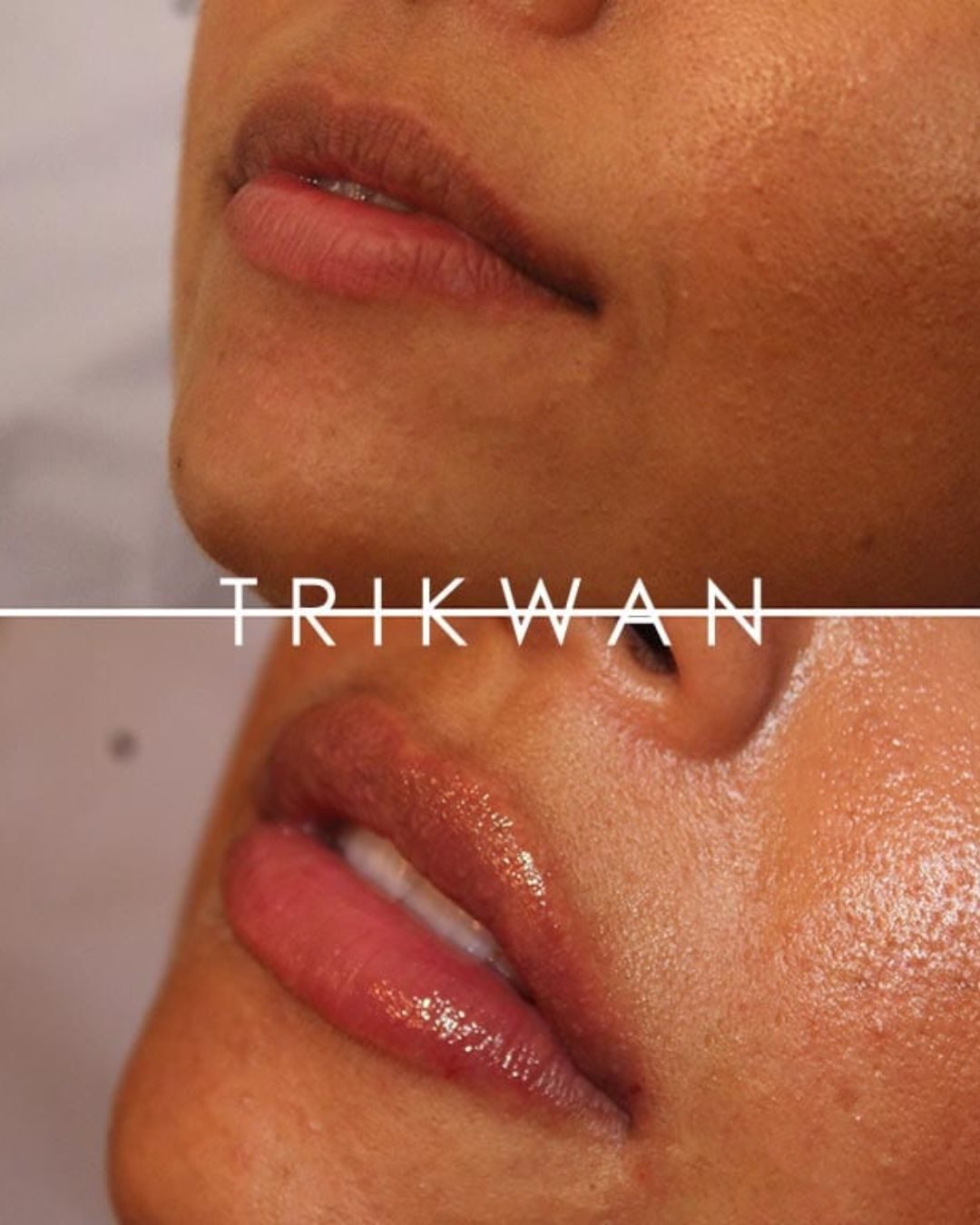 Lip filler before and after 1 — Trikwan Aesthetics