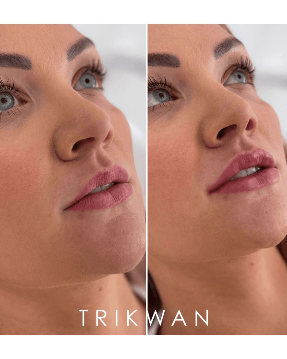 Cupid's Bow lip filler before and after — Trikwan Aesthetics
