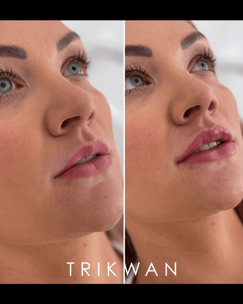 Cupid's Bow lip filler before and after — Trikwan Aesthetics