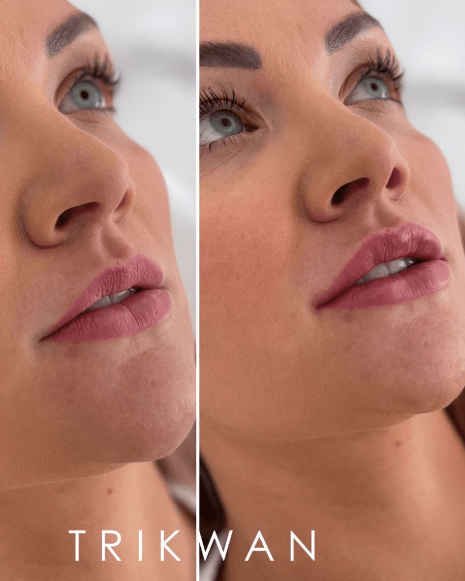 Lip filler before and after 3 — Trikwan Aesthetics