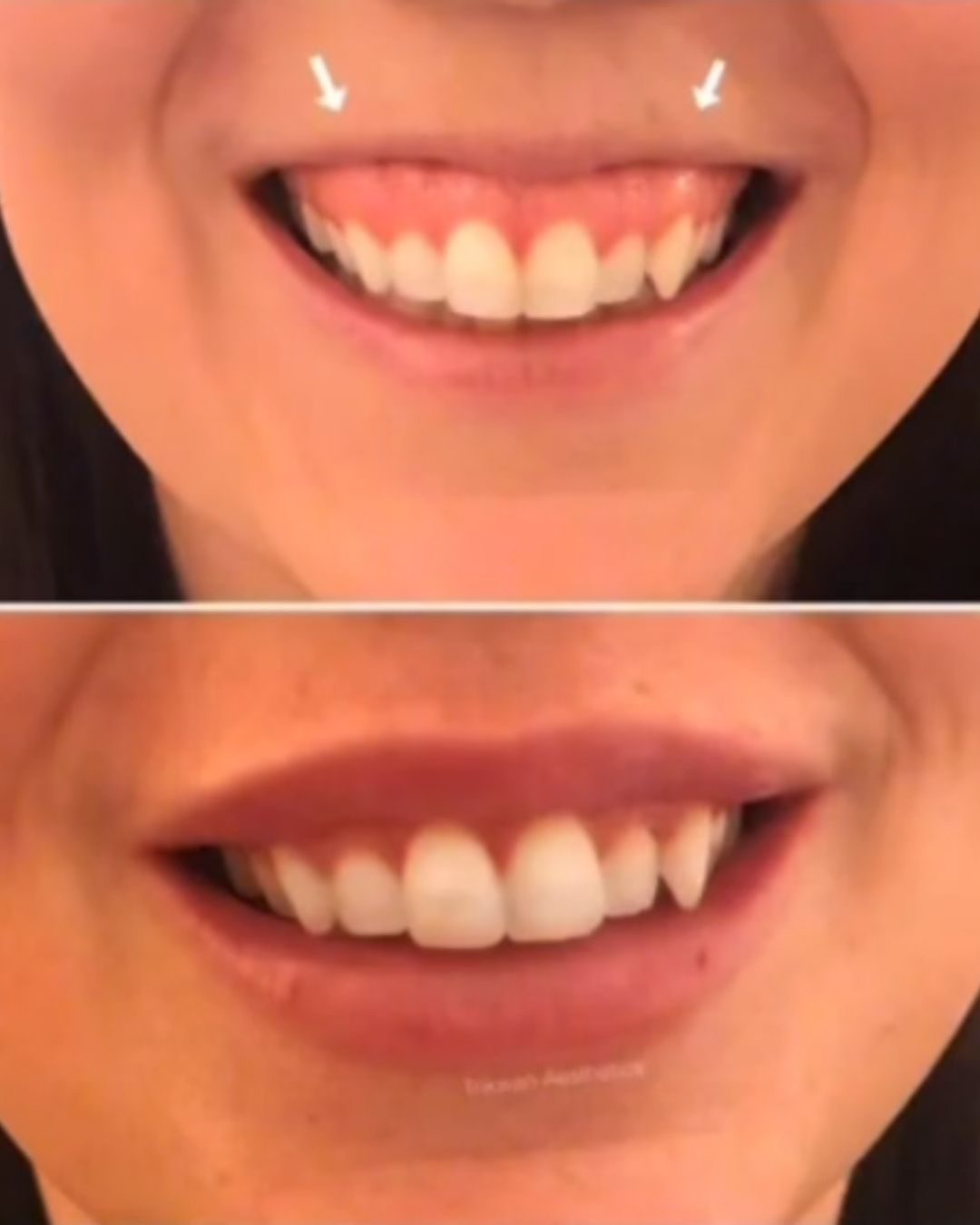 Lip filler before and after — Trikwan Aesthetics